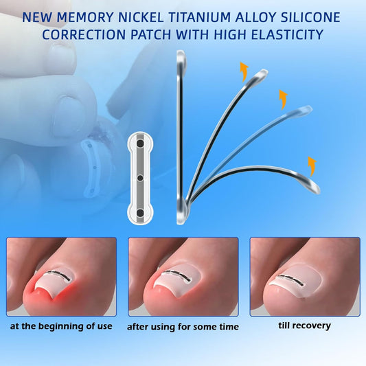 Correction patch, Ingrown Toenail Corrector, Nail correction tool,Ingrown Toenail Removal Kit,Cuttable Applicable for any nail size,Reusable